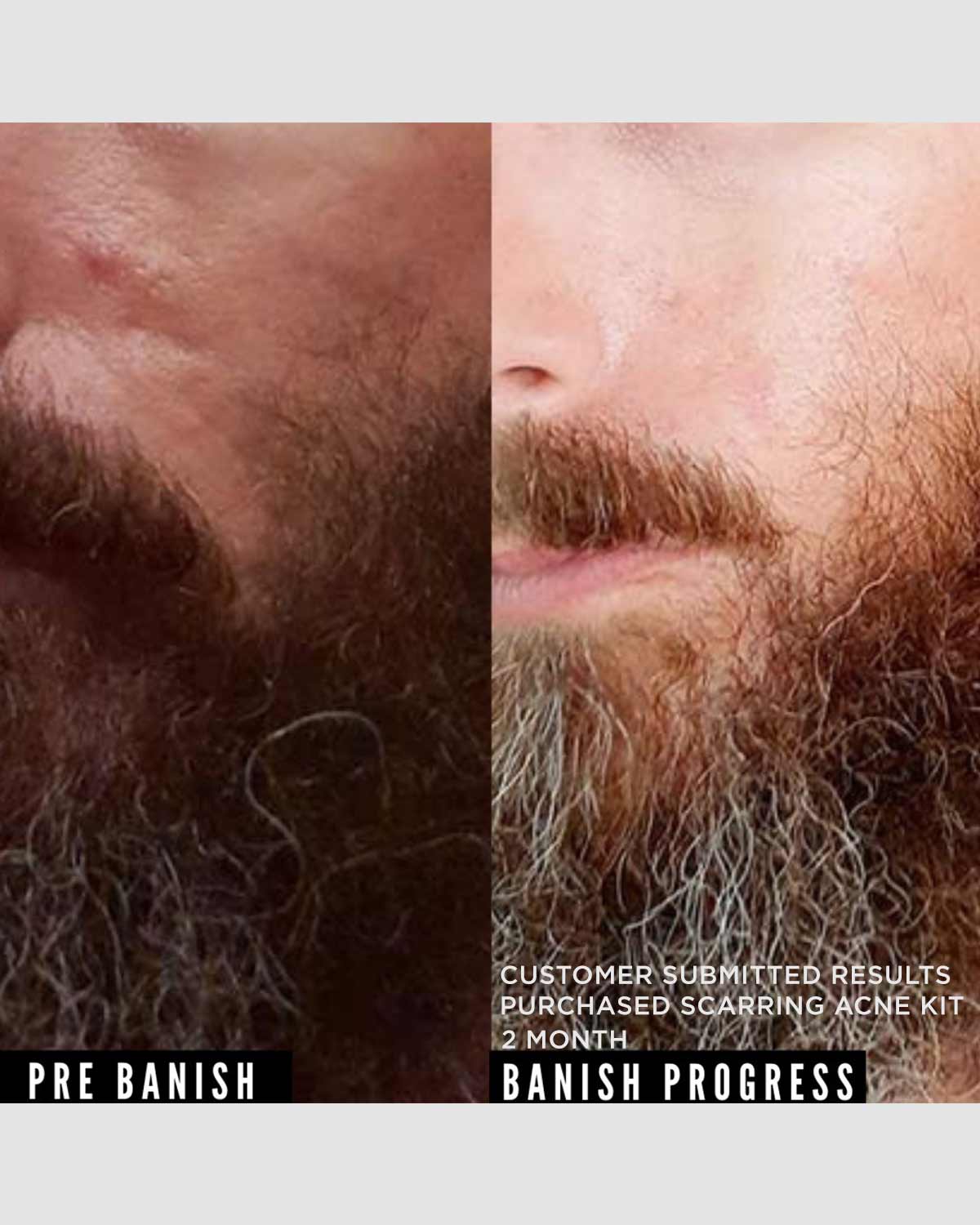 Scarring and Acne Kit