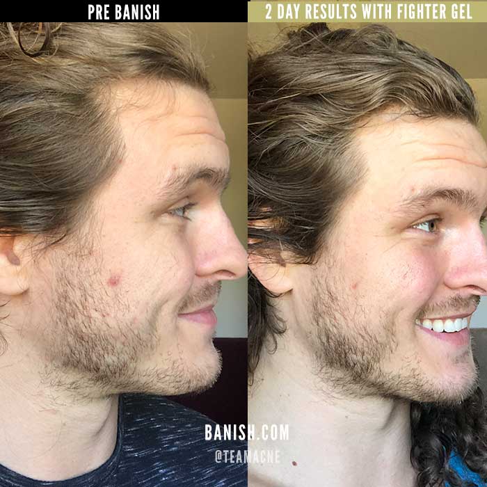 Fighter Gel - Breakout Calming Gel